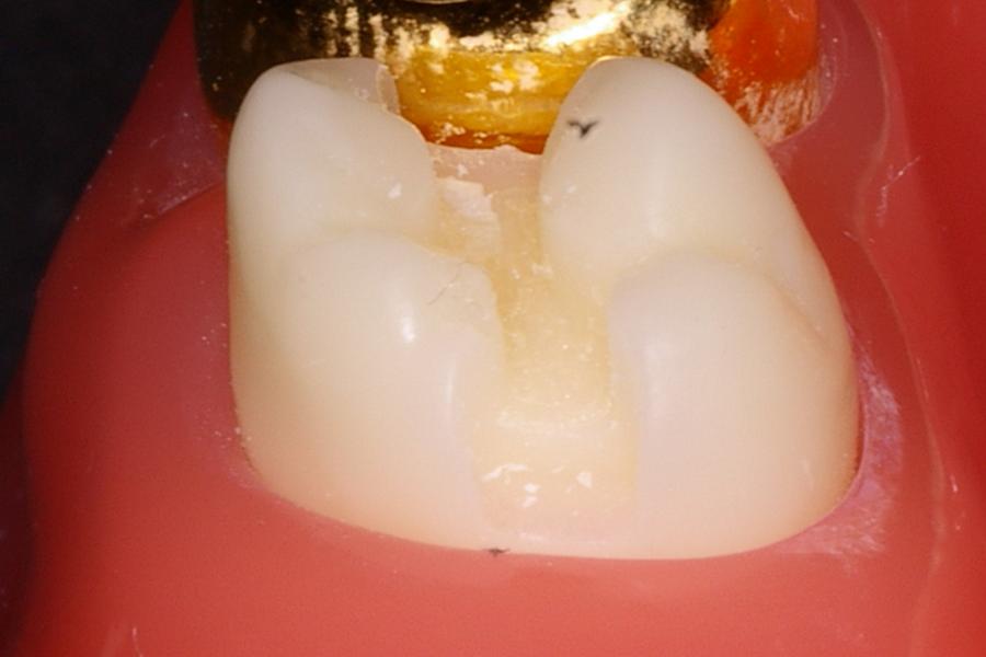 inlay prep dentist dental tooth ask crown