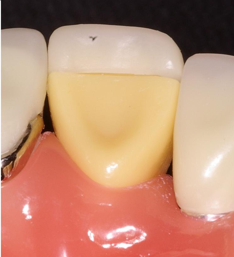 Laminate Veneer Ask A Dentist