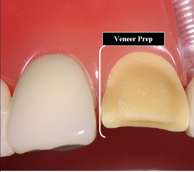 Laminate Veneer Ask A Dentist
