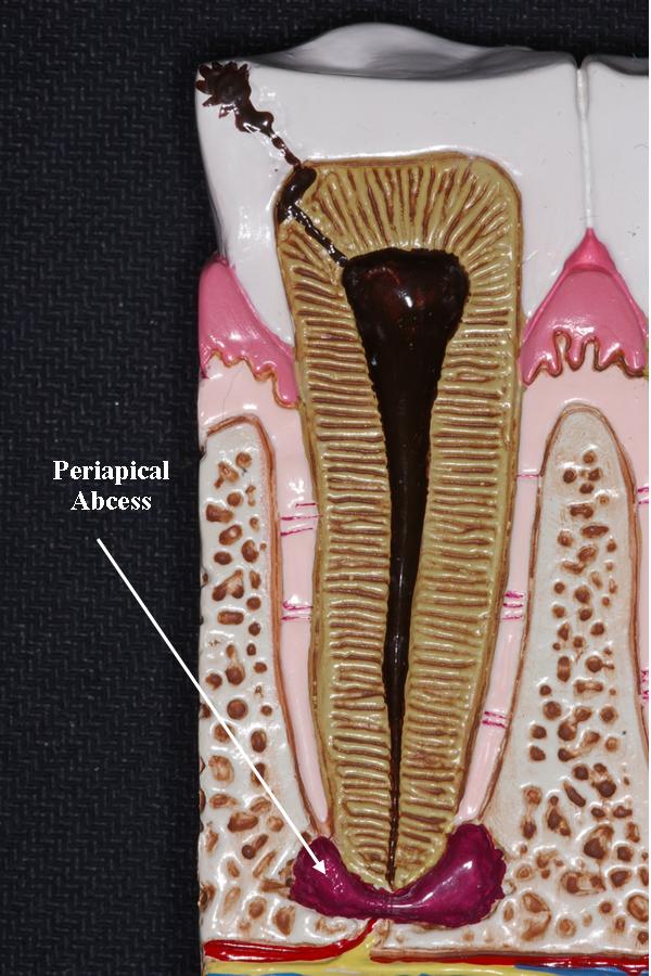 Periapical Abscess | Ask A Dentist