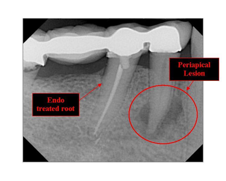 Periapical Abscess | Ask A Dentist