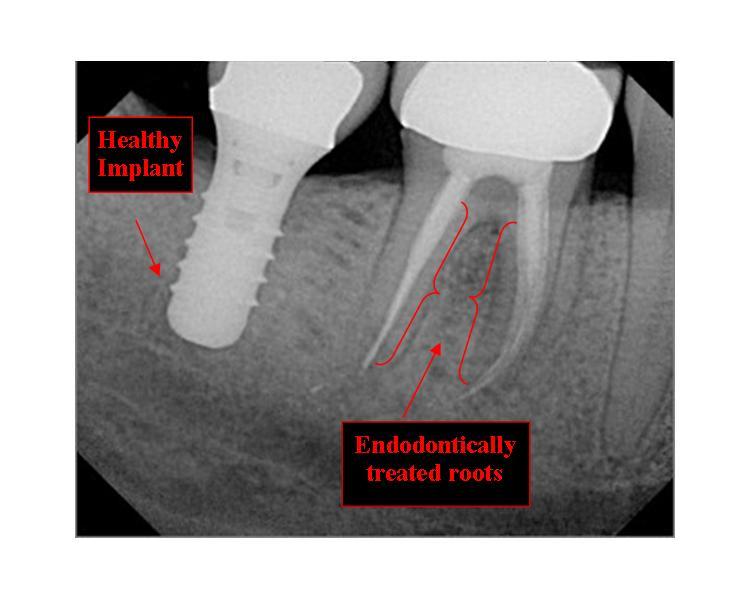 Root Canal Ask A Dentist