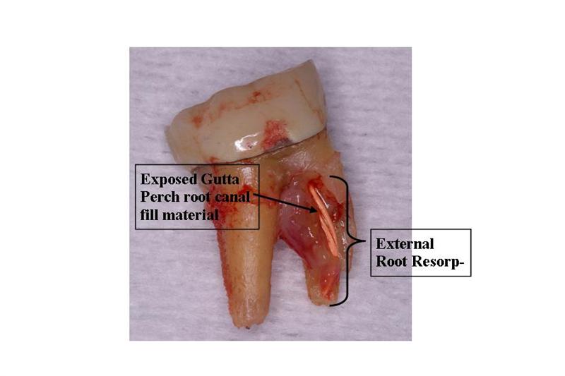 Resorption Ask A Dentist