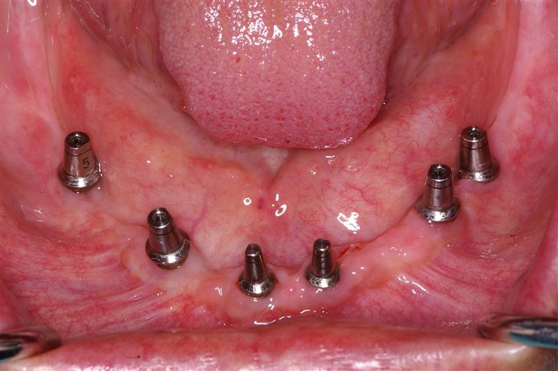 Stock Abutment Ask A Dentist
