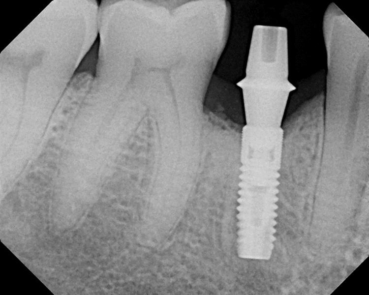 Stock Abutment Ask A Dentist