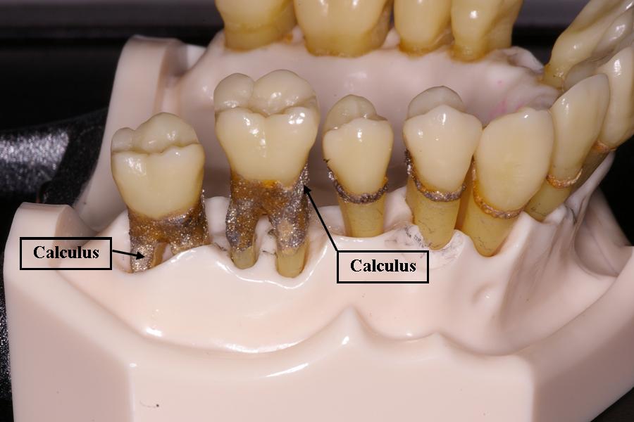 tartar-ask-a-dentist